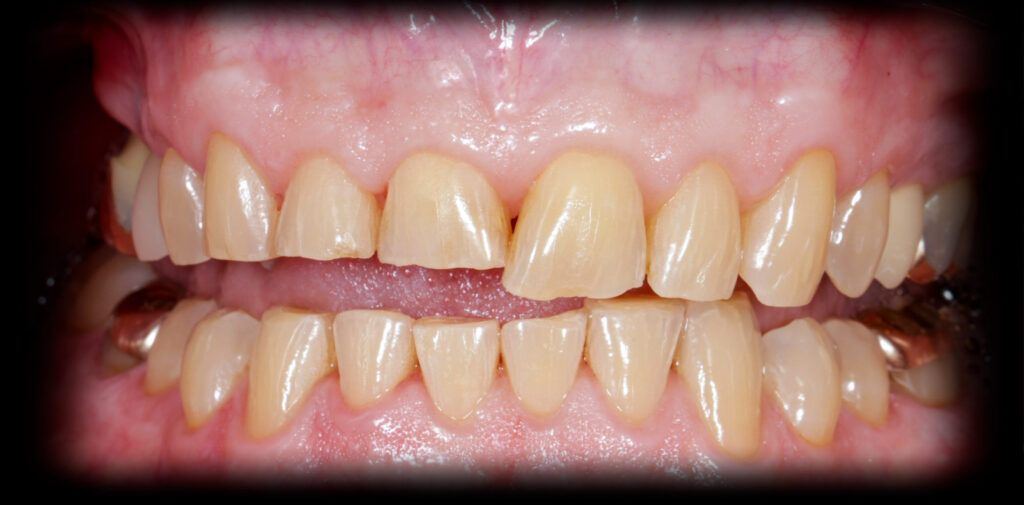 BRUXISM ADVANCE STATE